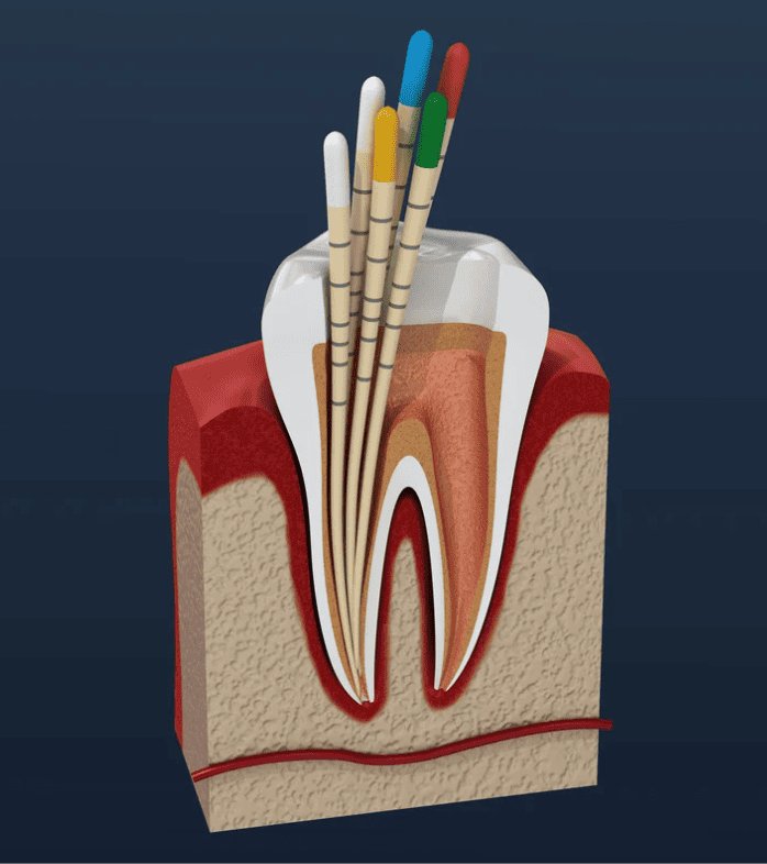 Endodoncia